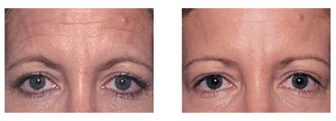 Before and after recommended use of Baby Quasar.