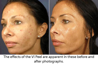 Before and seven days after the Vi Peel.