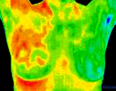 Thermal Breast Imaging
