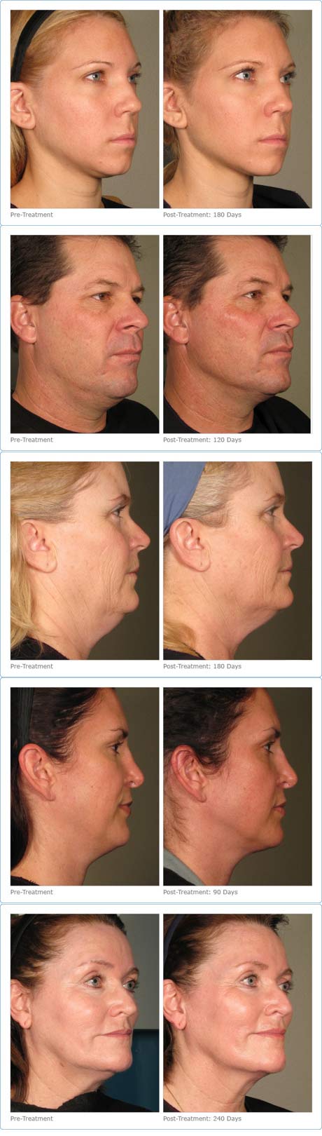 Rox Spa Ultherapy Before and After pictures