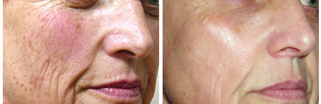 RoxSpa Non Surgical Face Lift - Before and After