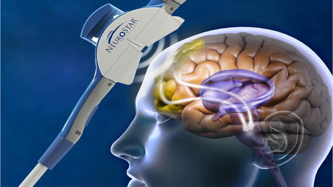 Transcranial Magnetic Stimulation (TMS) to treat depression