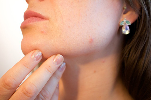 4 Ways to Deal With Stubborn Acne