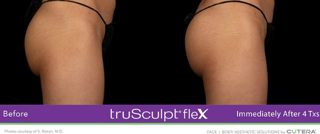 Trusculpt Flex muscle toning