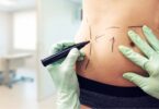 5 Factors to Consider Before Getting Tummy Tuck Surgery