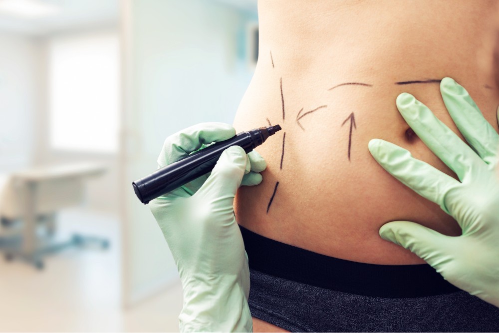 5 Factors to Consider Before Getting Tummy Tuck Surgery