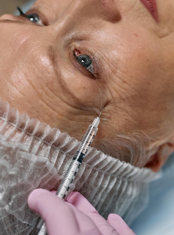 Neuramis Deep Lido – Filler Against Deep Wrinkles