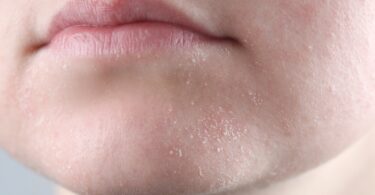 Drinking Water Alone Won’t Save Your Dry Skin