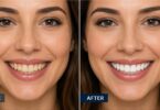 When Whitening Strips Fail Dentist